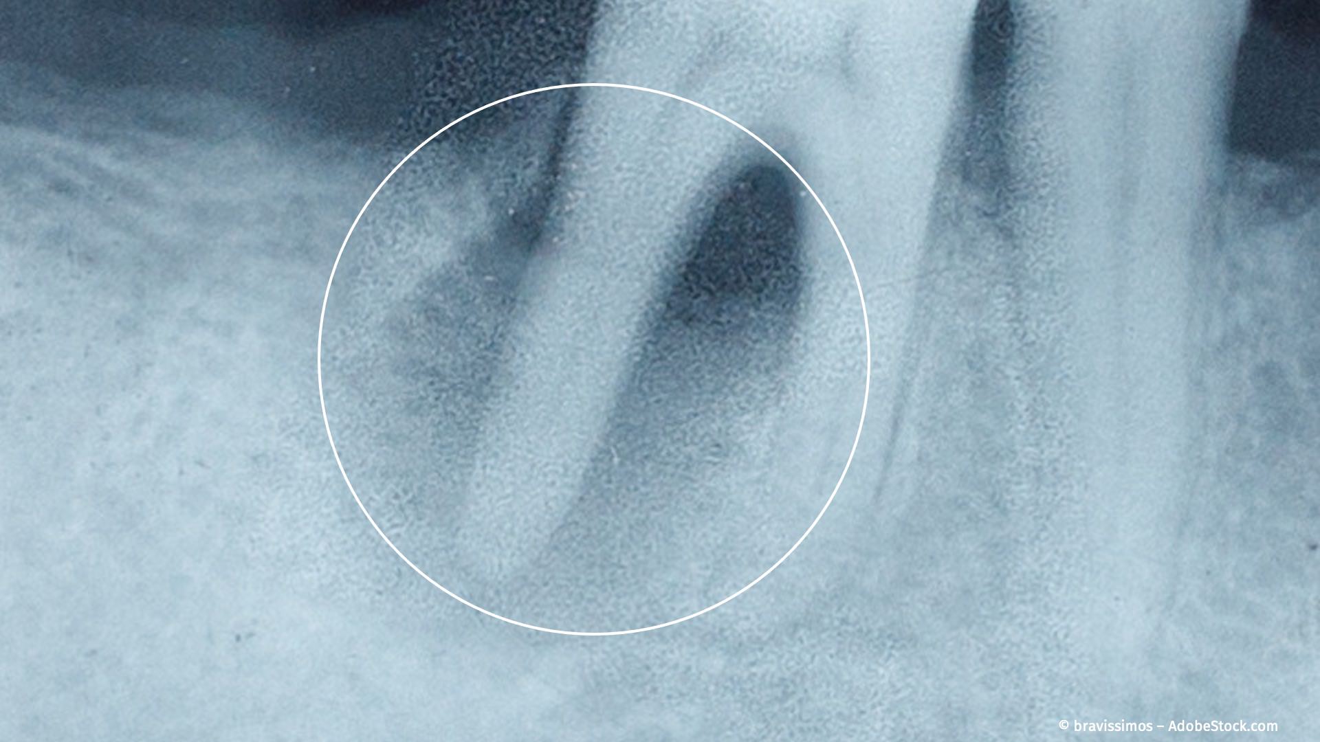 Wurzelbehandlung toter Zähne Zahnarzt Backnang